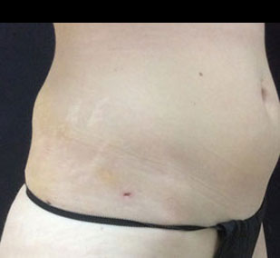 hip roll smartlipo after picture