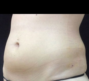 hip roll smartlipo after picture in fort myers