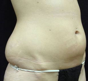 hip roll smart lipo before picture