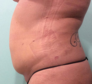 smartlipo after picture