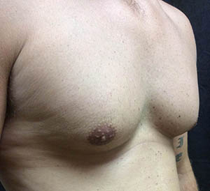 male breast reduction surgery before pic