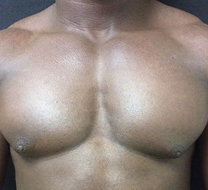 after male breast reduction