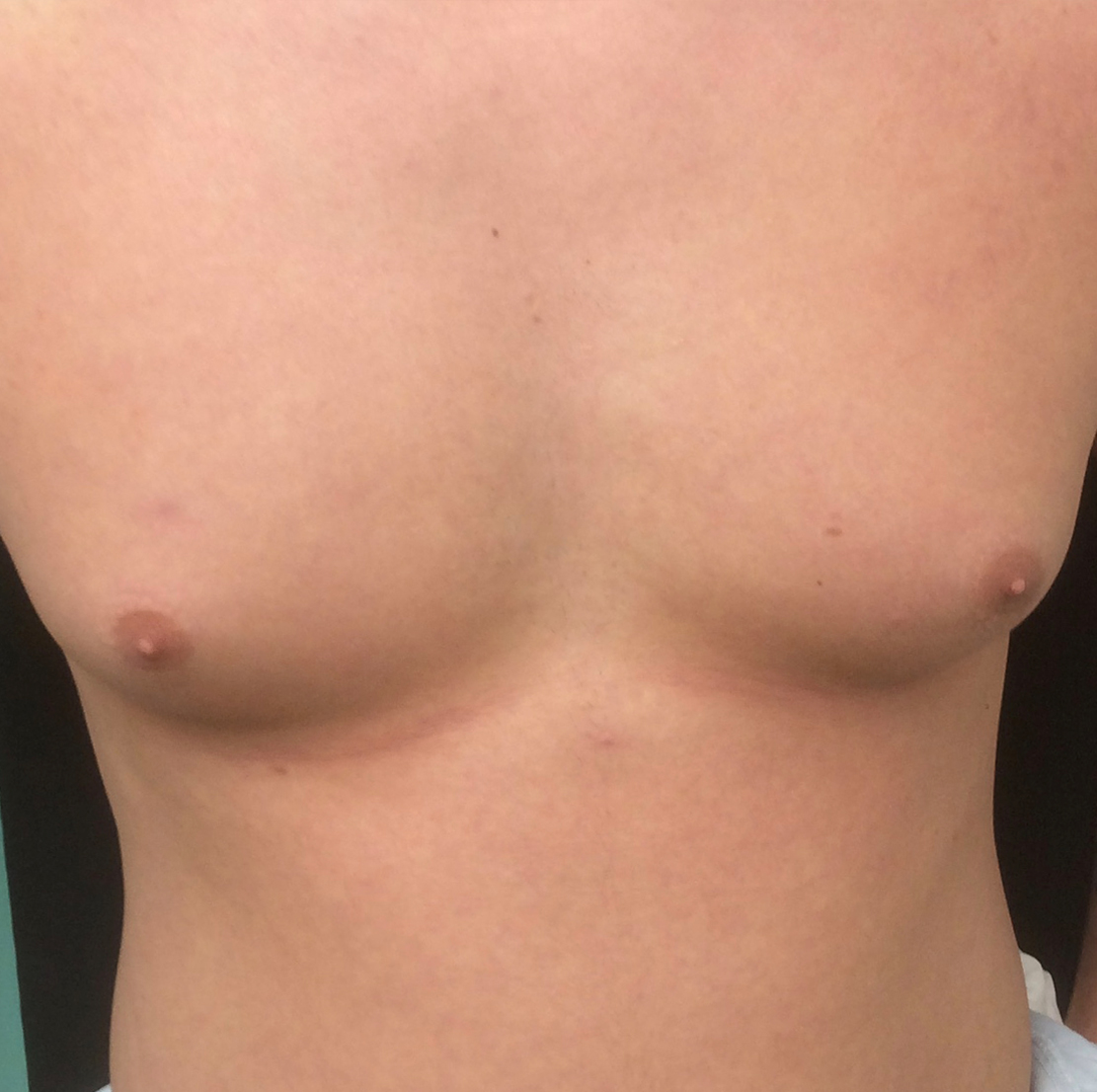 man breast reduction before pic