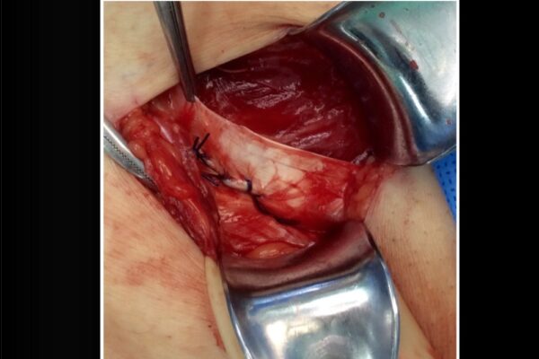 Muscle being cut 1 inch above ligament forming a strip